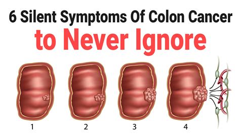 But there are some things you can do. . Colon cancer and muscle twitching